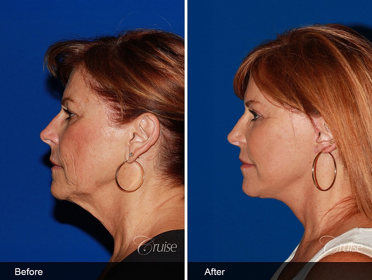 Face Lift Before & After