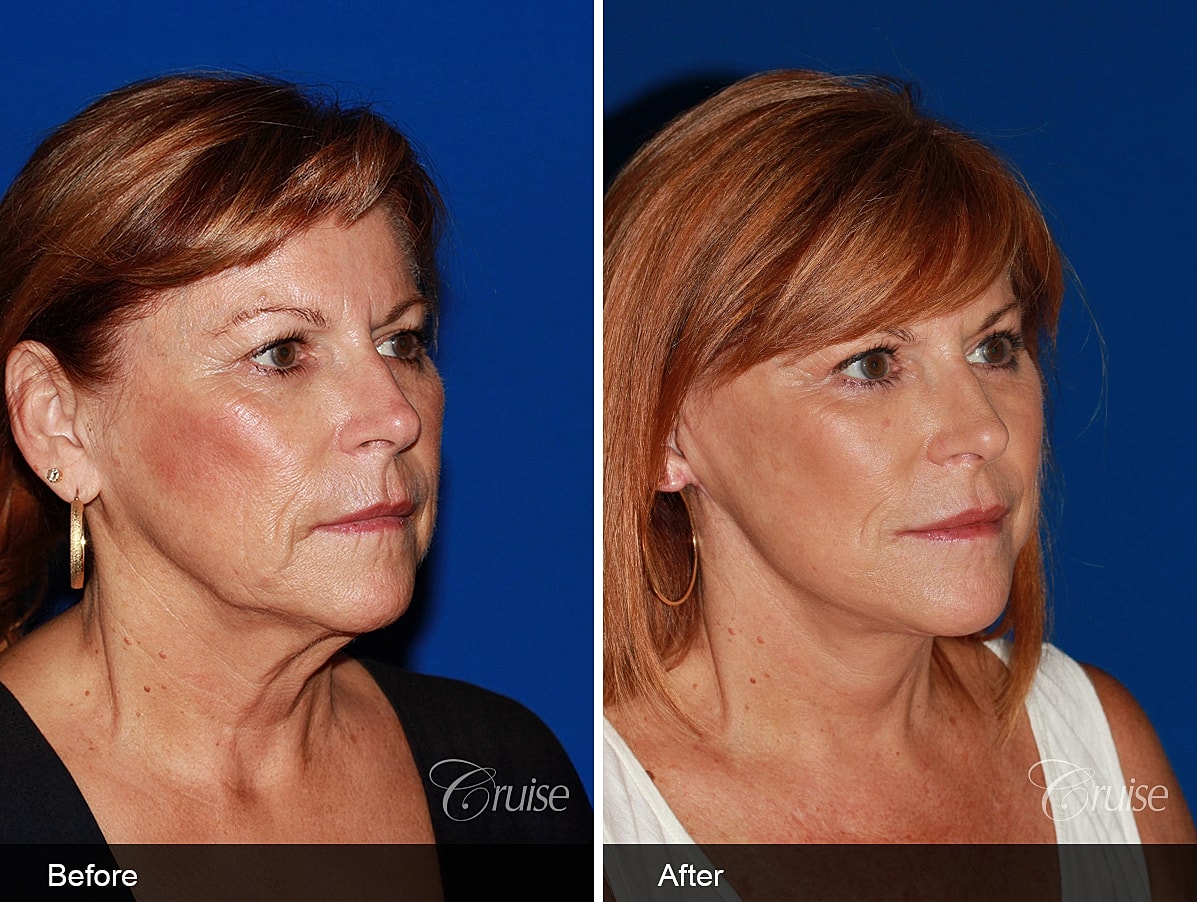 Face Lift Before & After