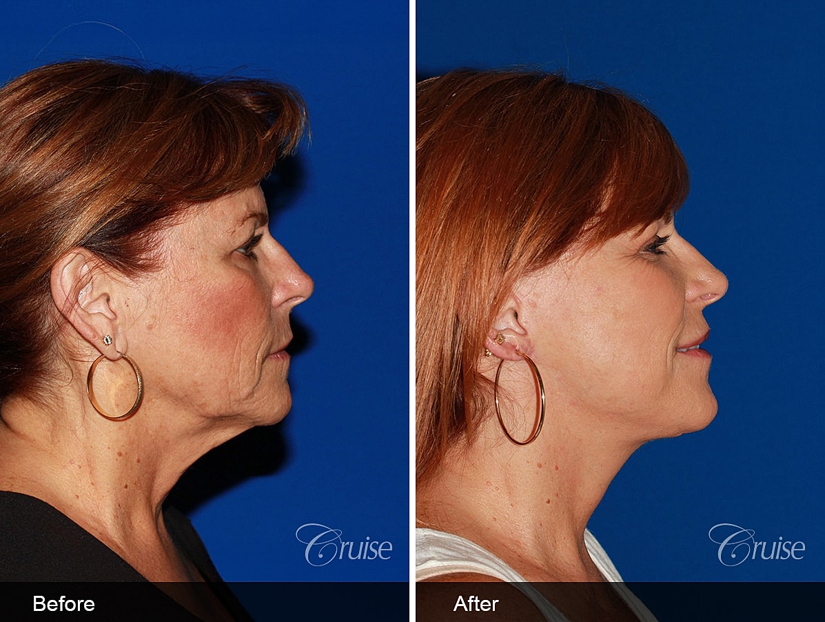 Face Lift Before & After