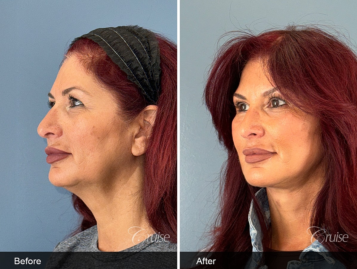 Female facelift and neck lift before and after at 3 weeks post-op in a 60-year-old woman, showing improved jawline definition and smoother neck contour in Southern California.