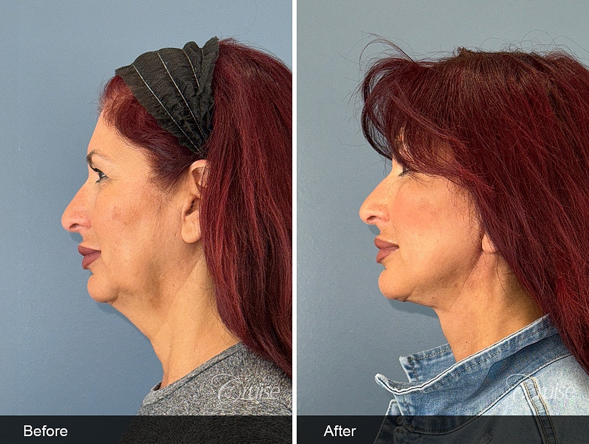 Female facelift and neck lift before and after at 3 weeks post-op in a 60-year-old woman, showing improved jawline definition and smoother neck contour in Southern California.