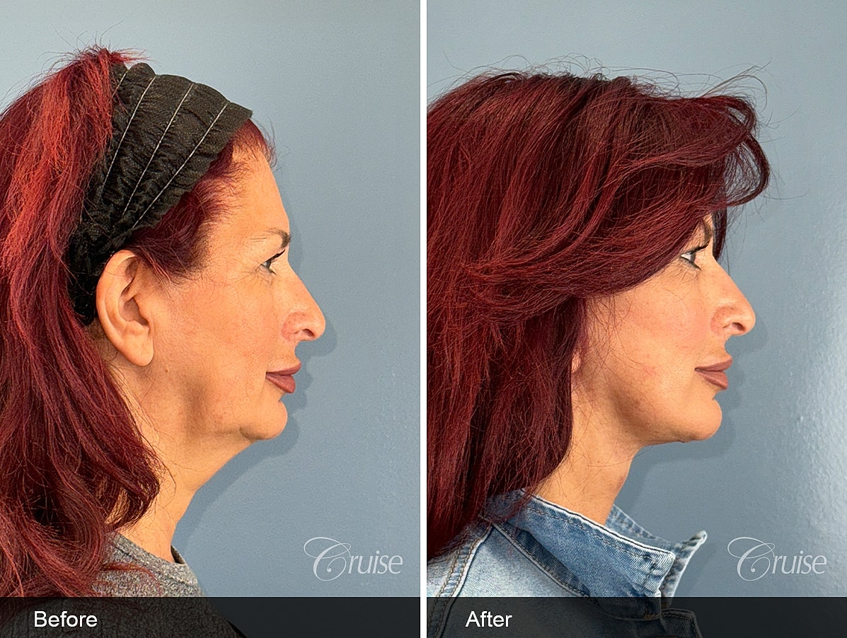 Female facelift and neck lift before and after at 3 weeks post-op in a 60-year-old woman, showing improved jawline definition and smoother neck contour in Southern California.