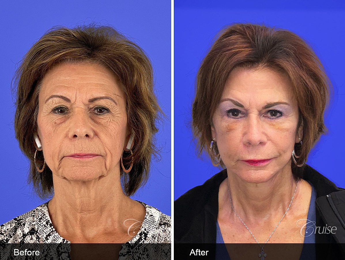 Face Lift Before & After