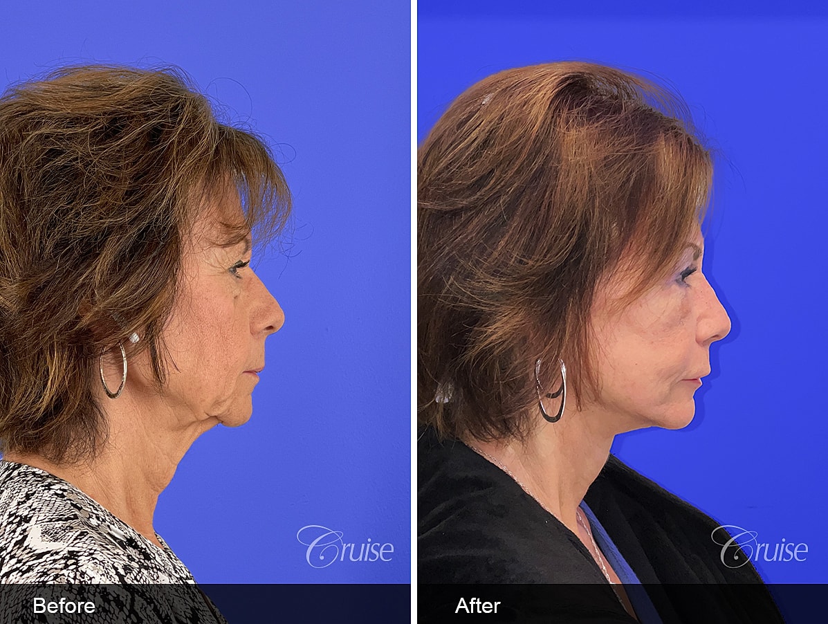 Face Lift Before & After