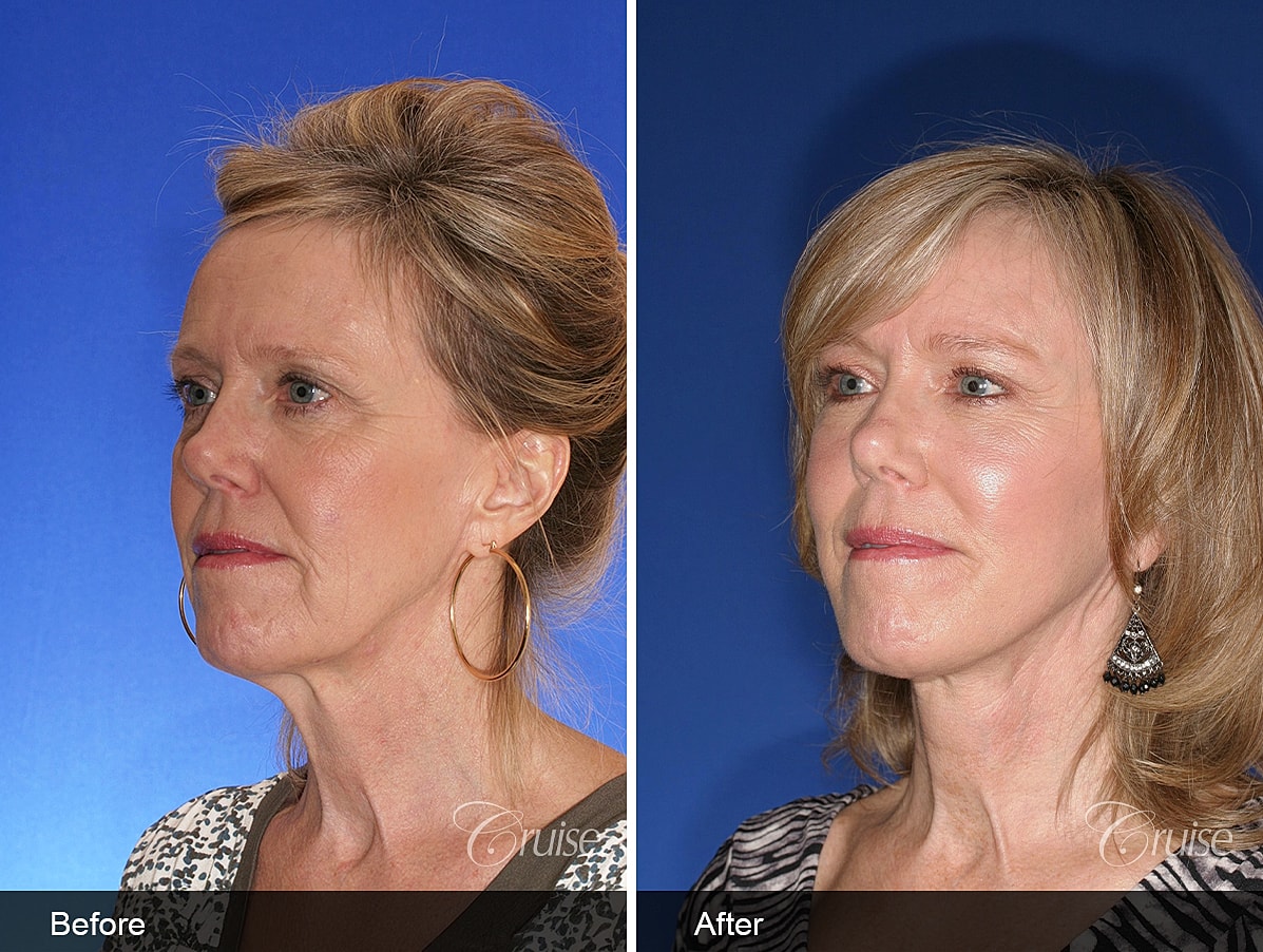 Face Lift Before & After