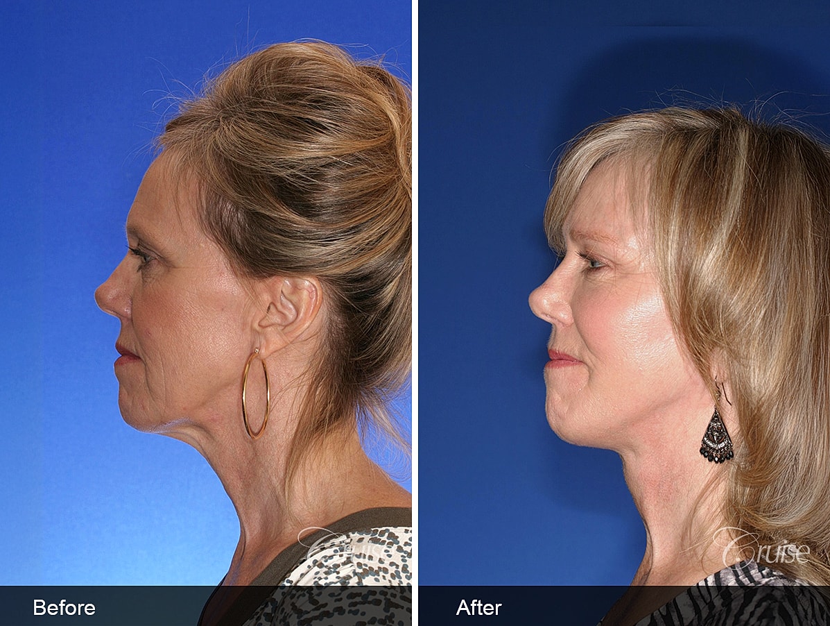 Face Lift Before & After