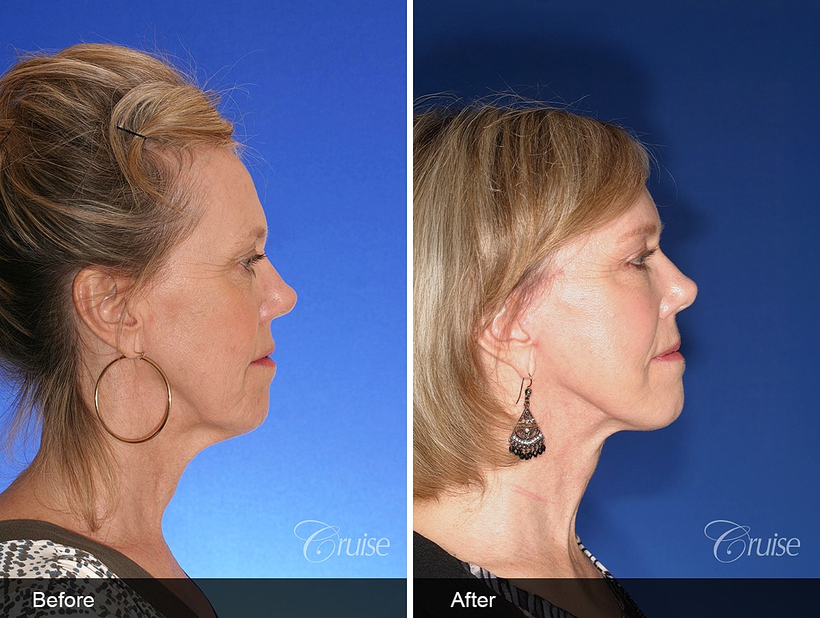 Face Lift Before & After