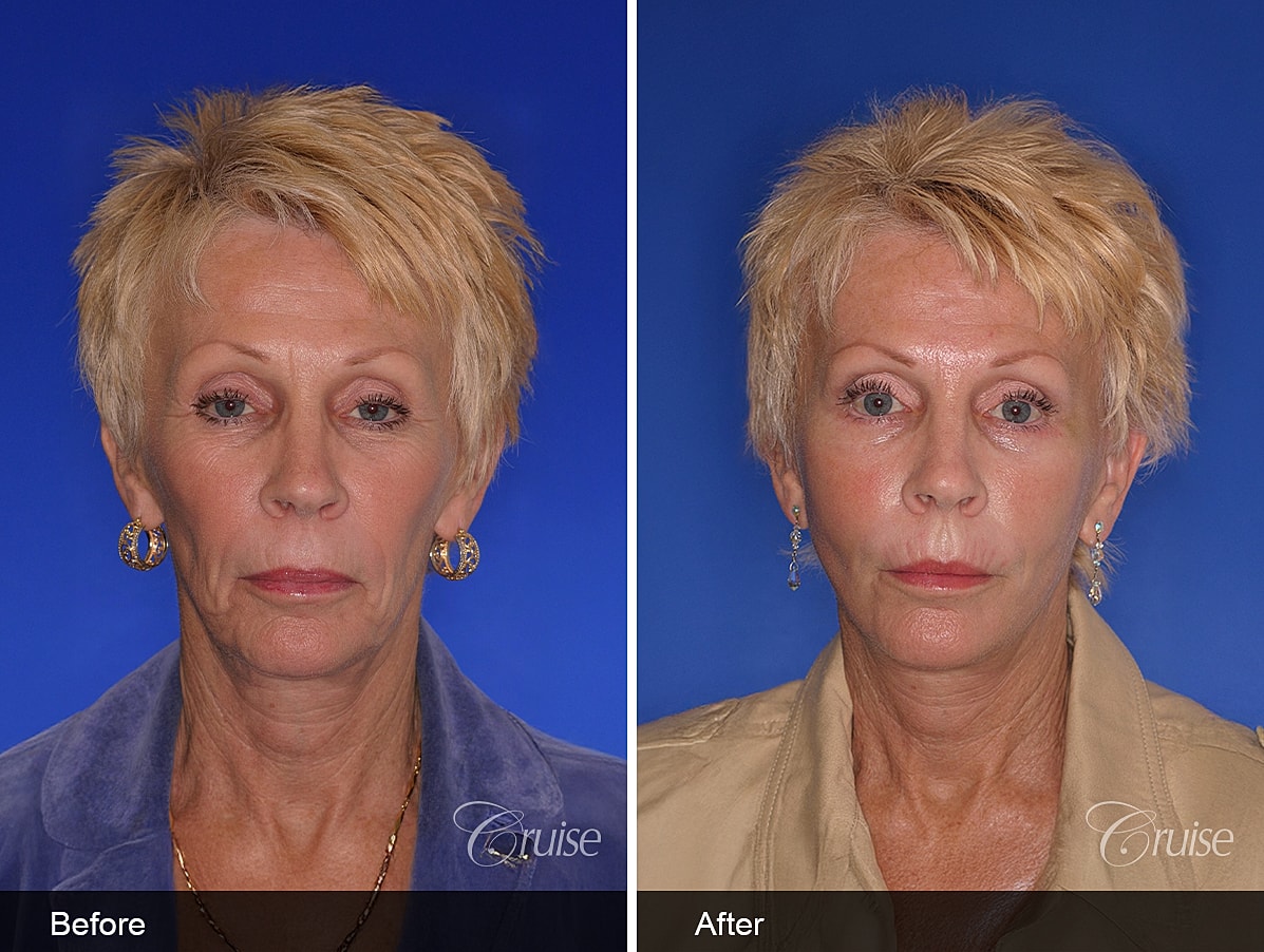 Face Lift Before & After