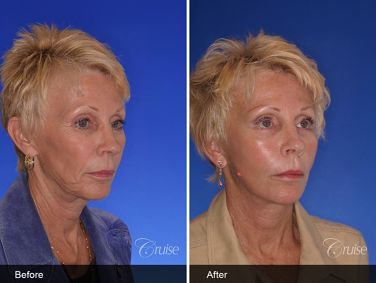 Face Lift Before & After
