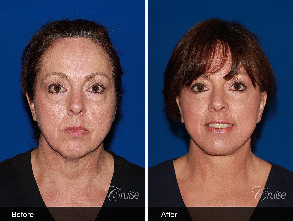 Face Lift Before & After
