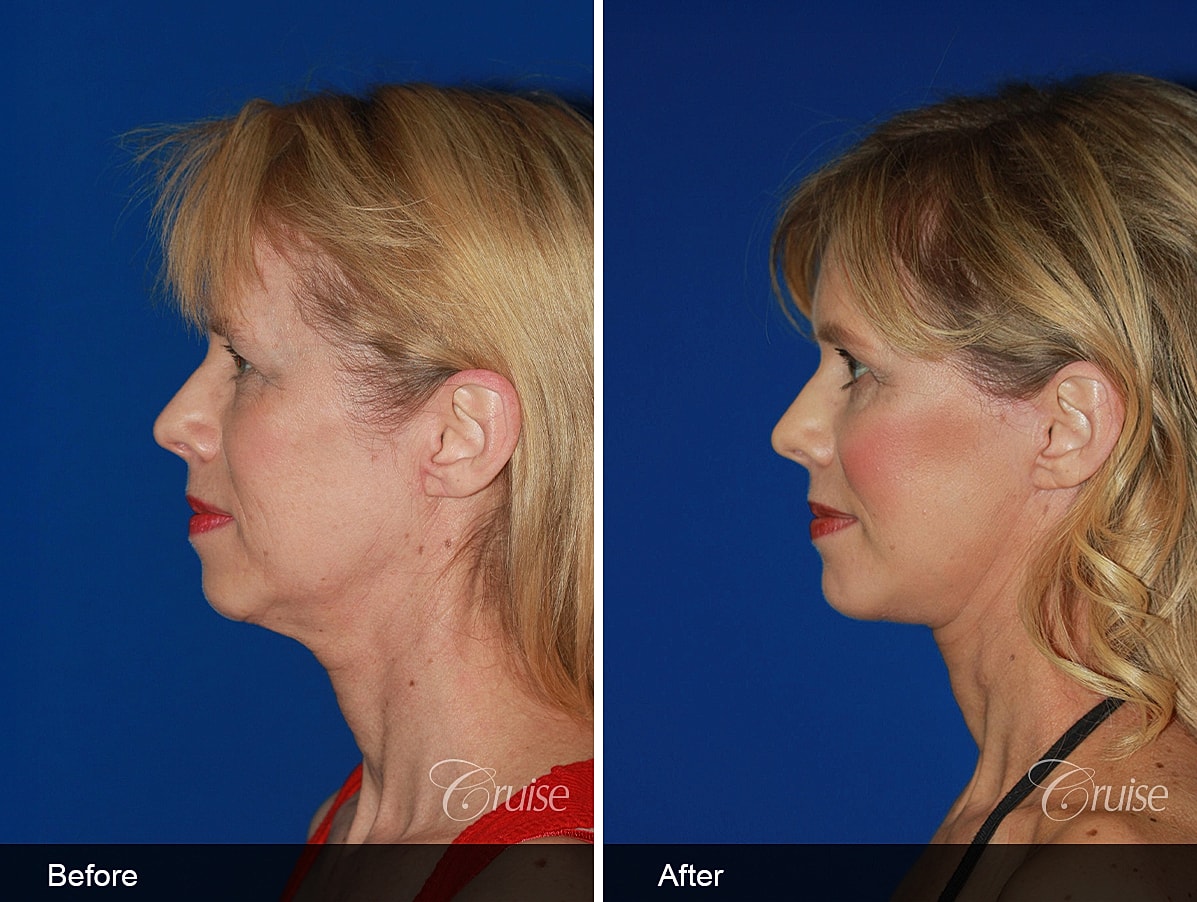 Face Lift Before & After