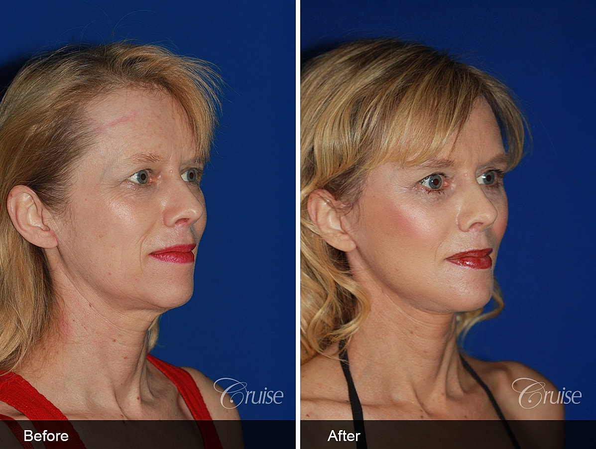 Face Lift Before & After
