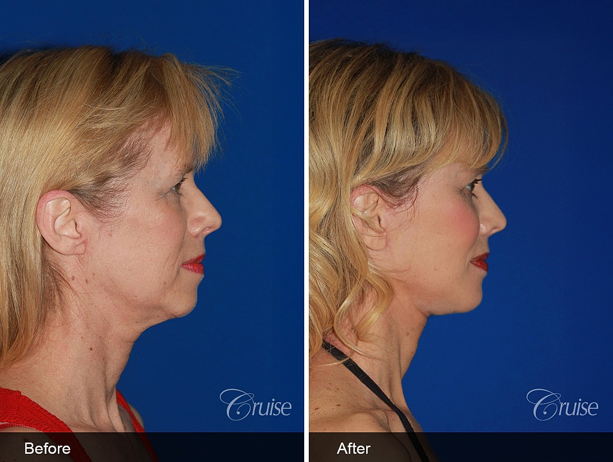 Face Lift Before & After