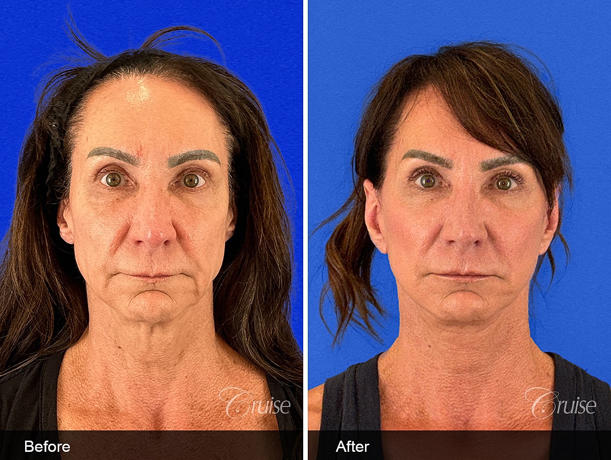 Face Lift Before & After