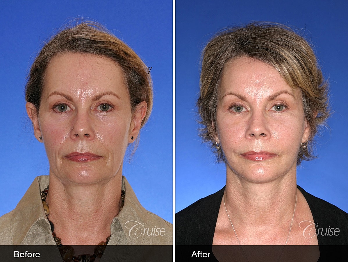 Face Lift Before & After