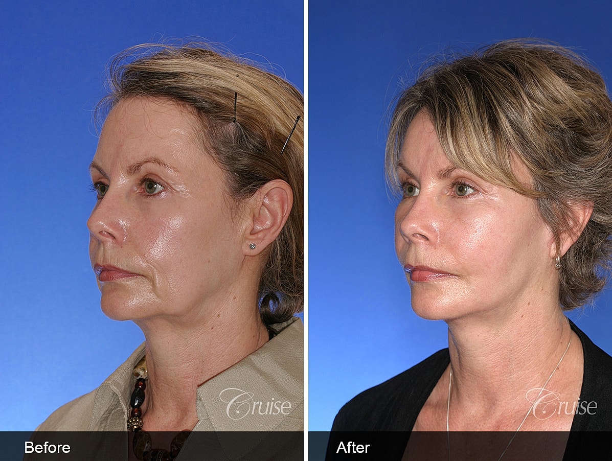 Face Lift Before & After