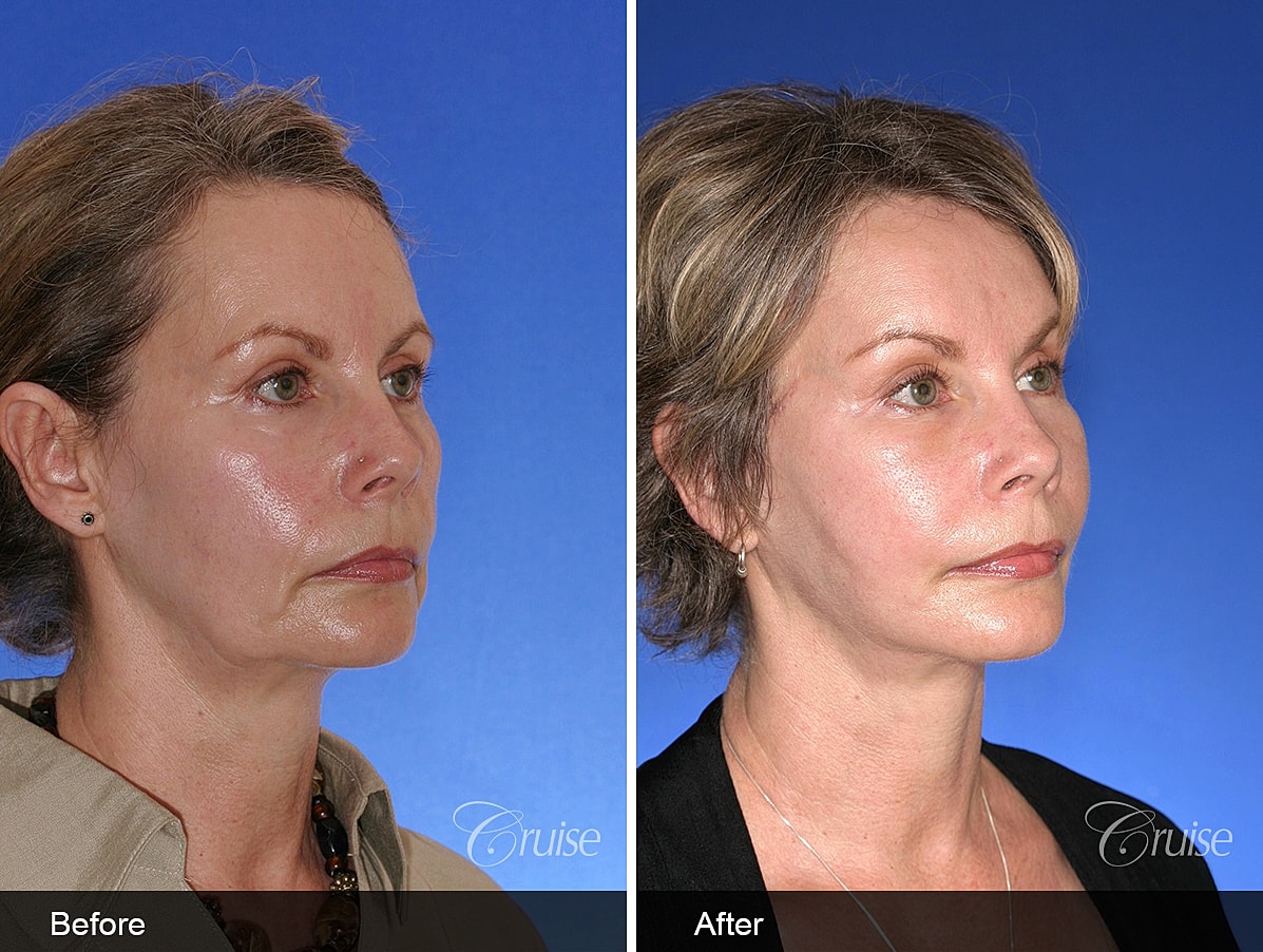 Face Lift Before & After