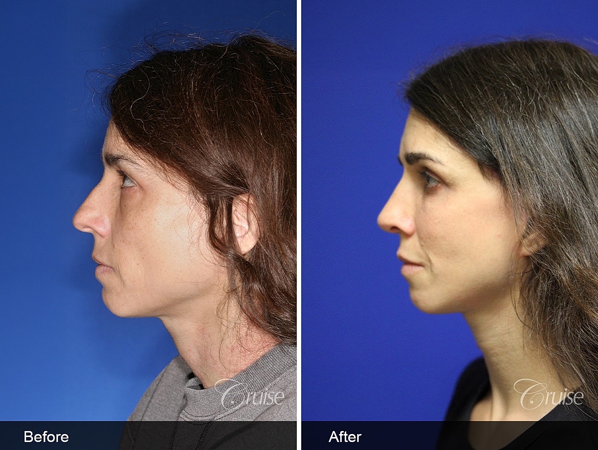 Face Lift Before & After