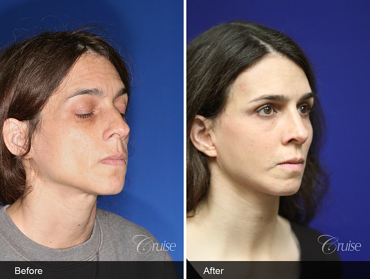 Face Lift Before & After