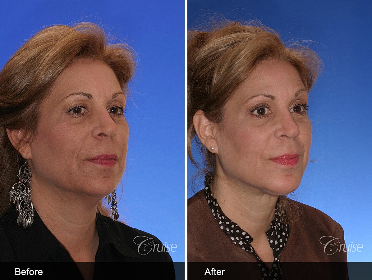 Face Lift Before & After