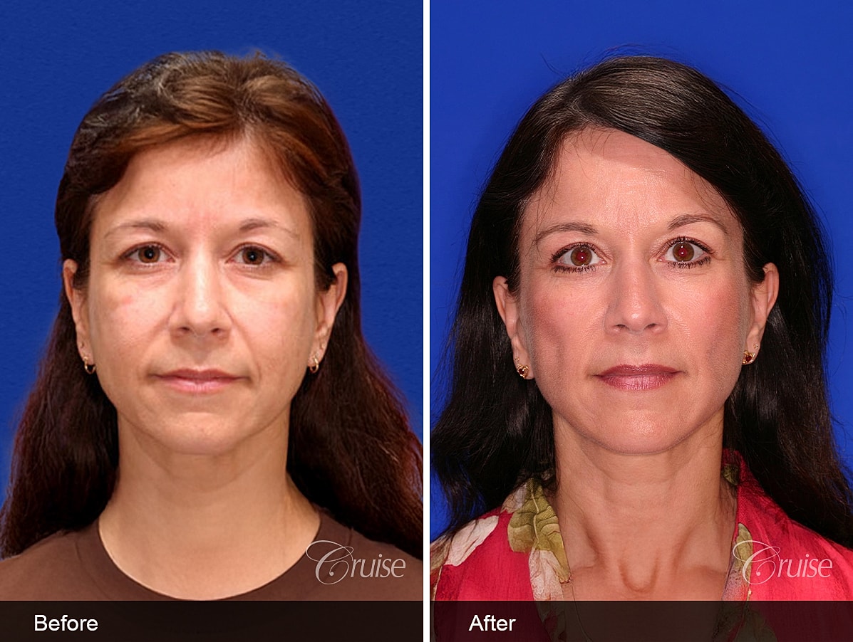 Face Lift Before & After