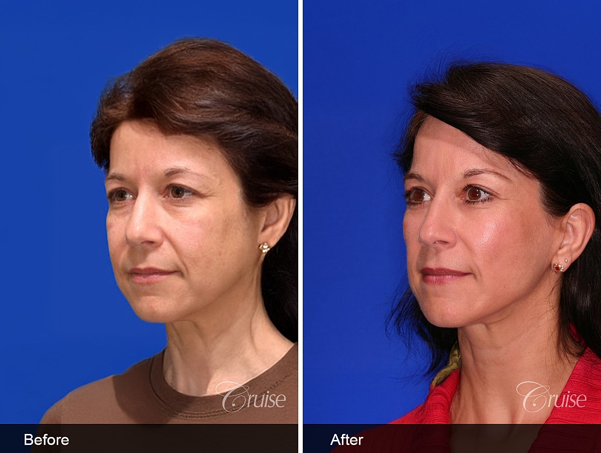 Face Lift Before & After