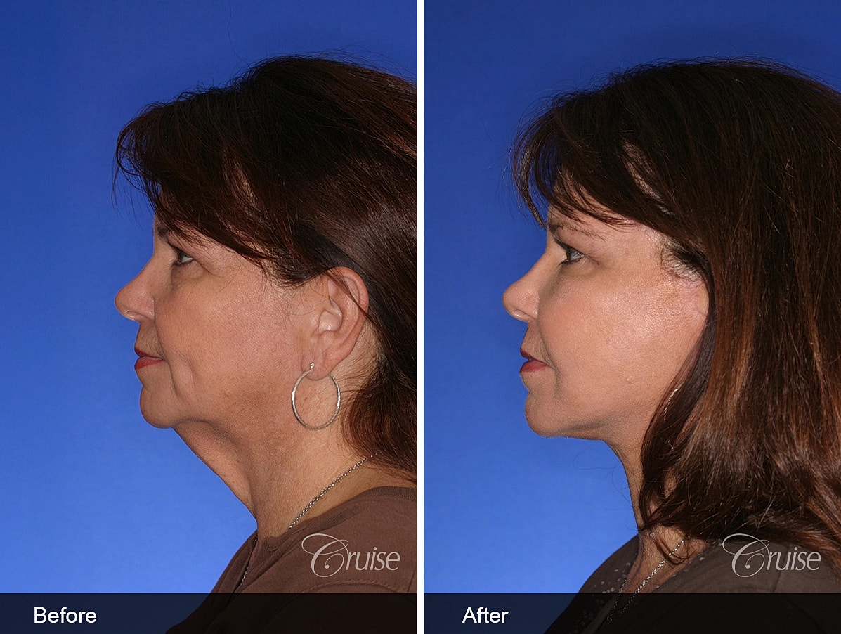 Face Lift Before & After