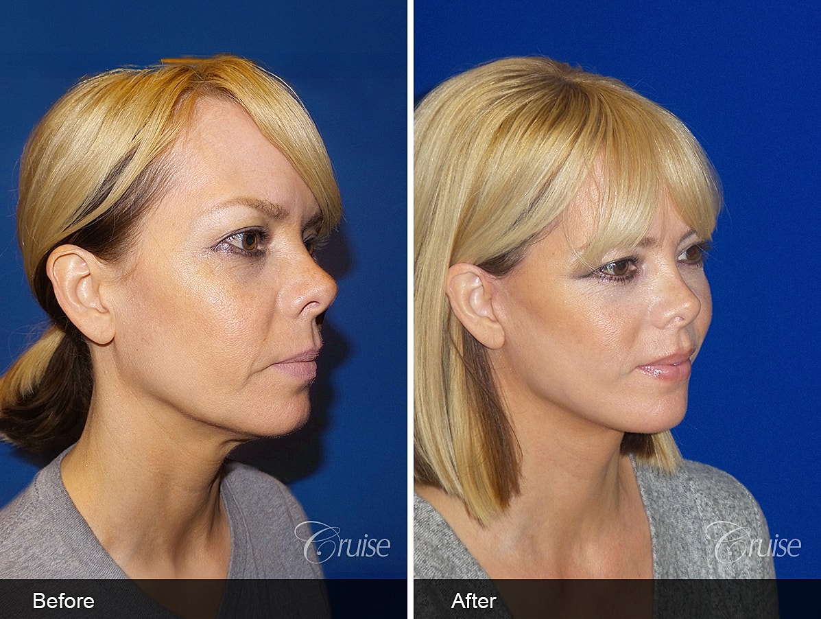 Face Lift Before & After
