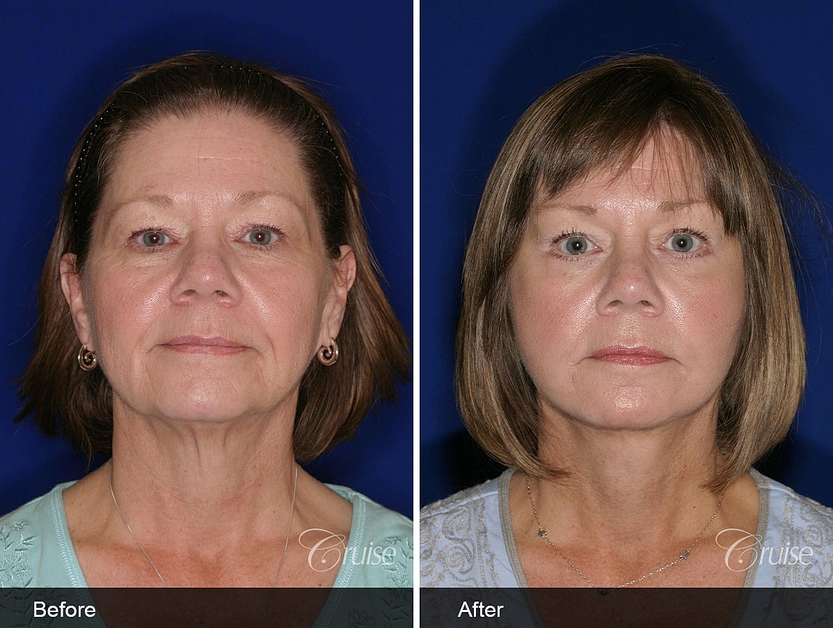 Face Lift Before & After