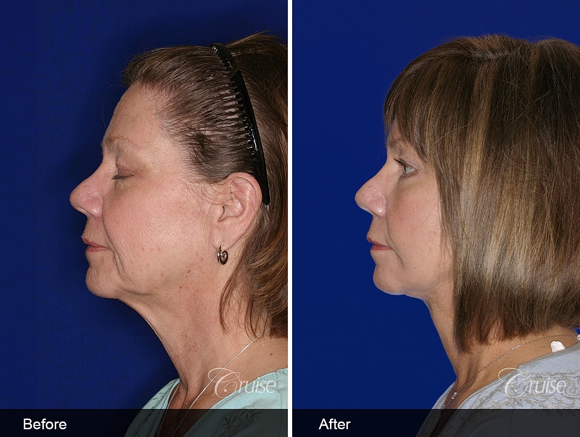 Face Lift Before & After