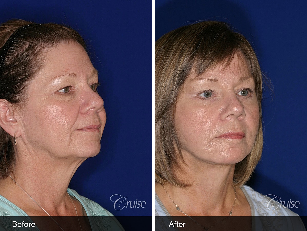 Face Lift Before & After