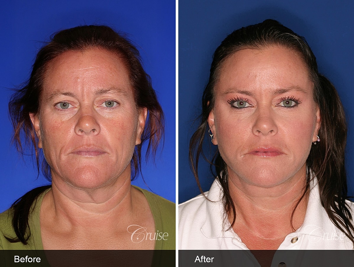 Face Lift Before & After