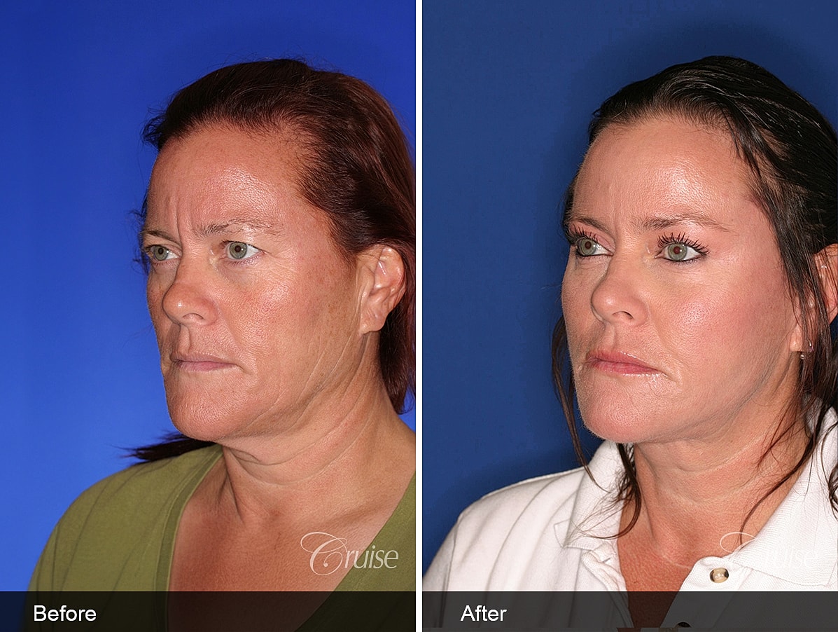 Face Lift Before & After
