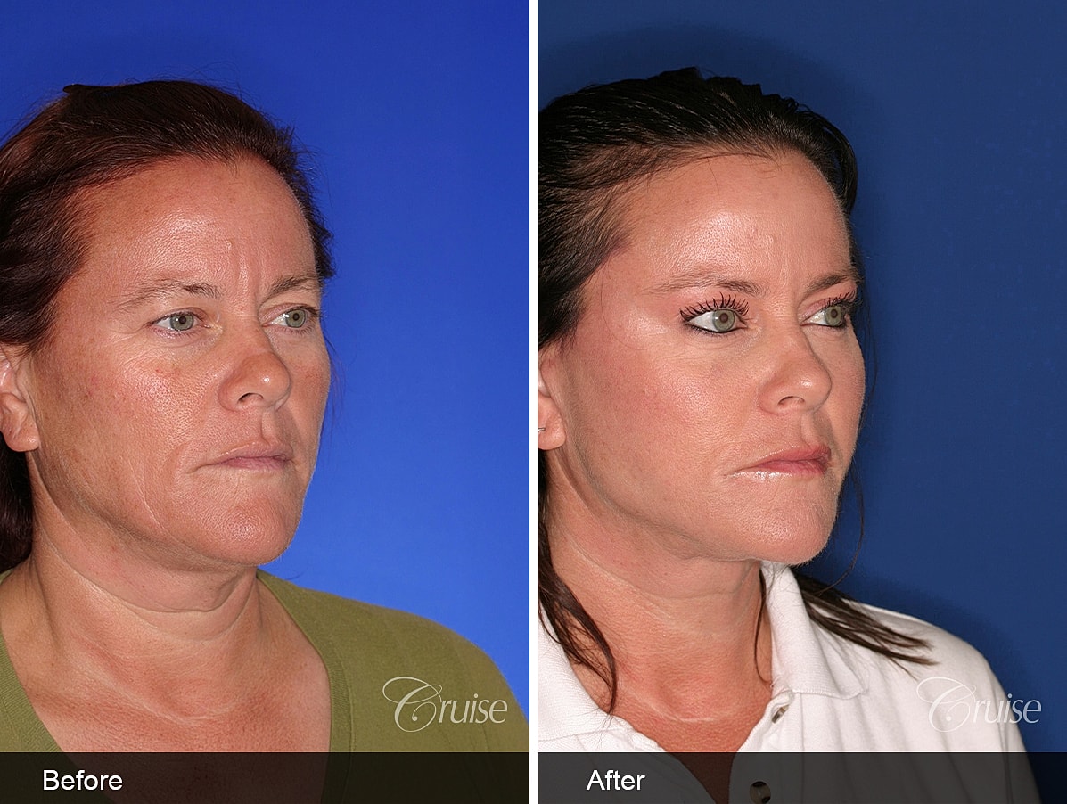 Face Lift Before & After