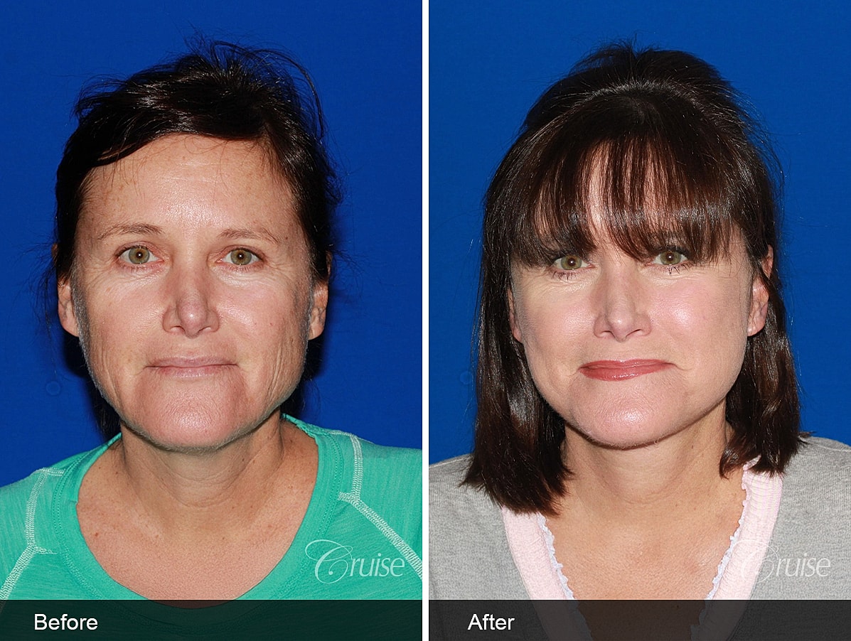 Face Lift Before & After