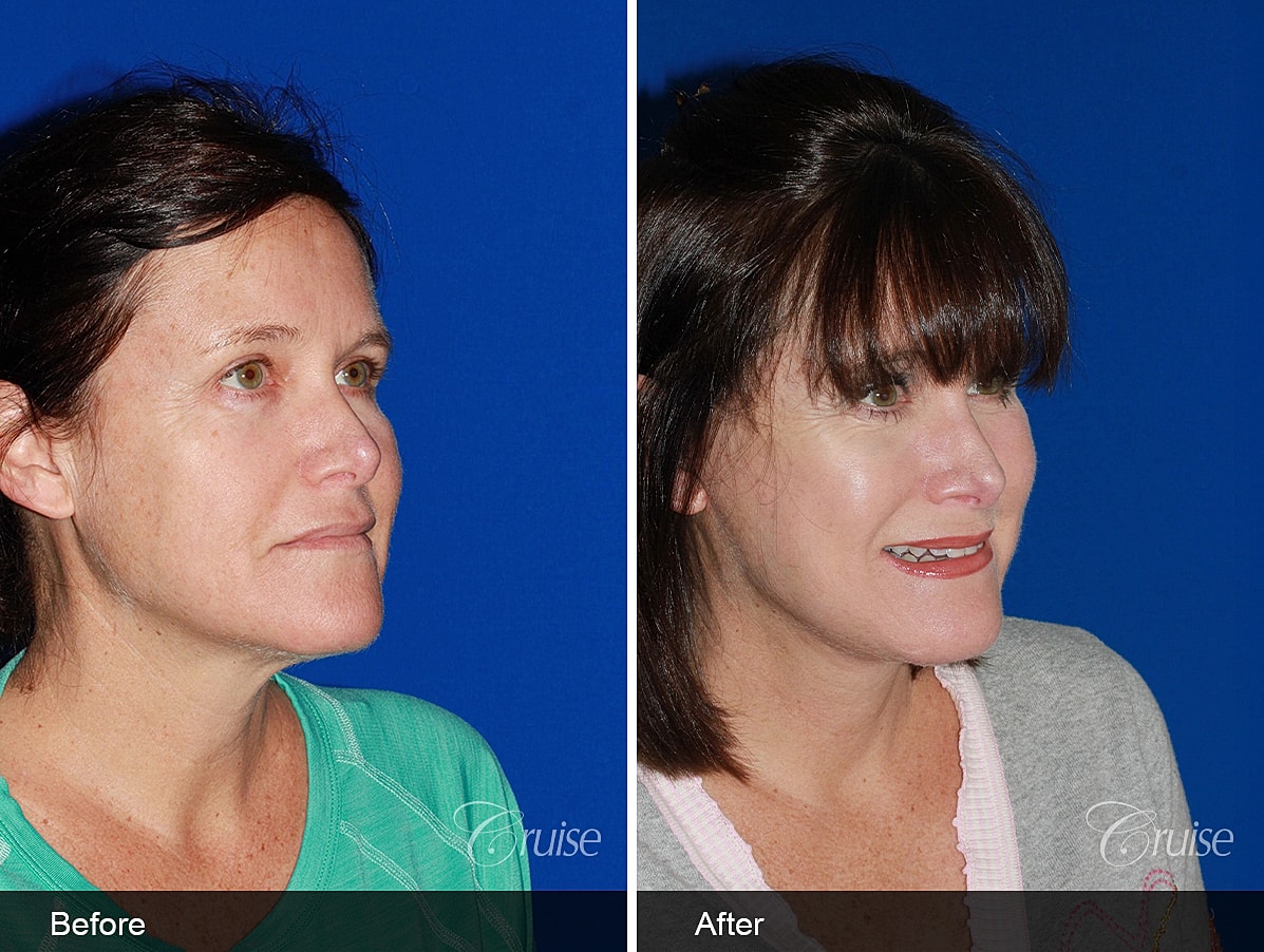 Face Lift Before & After