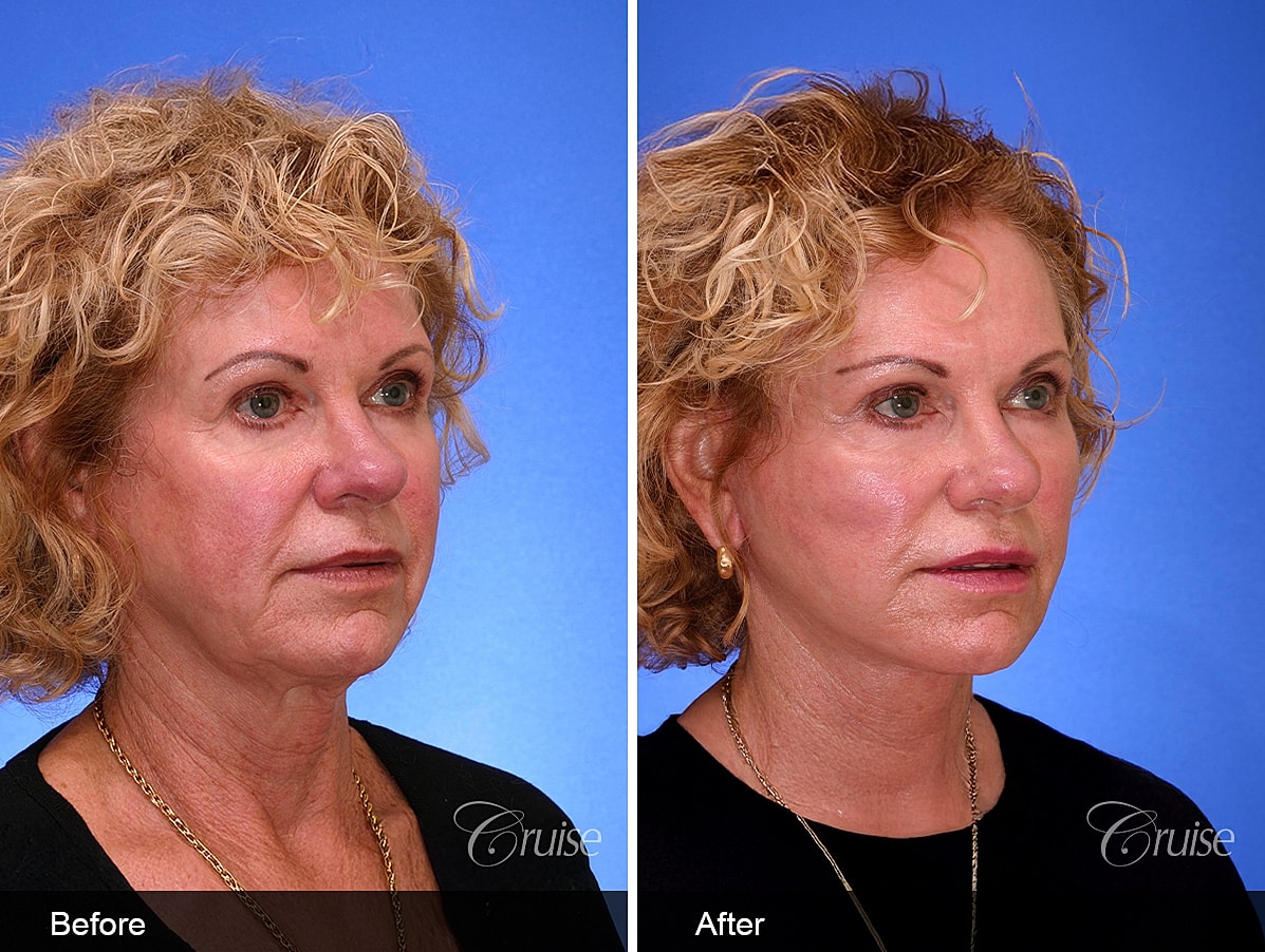 Face Lift Before & After