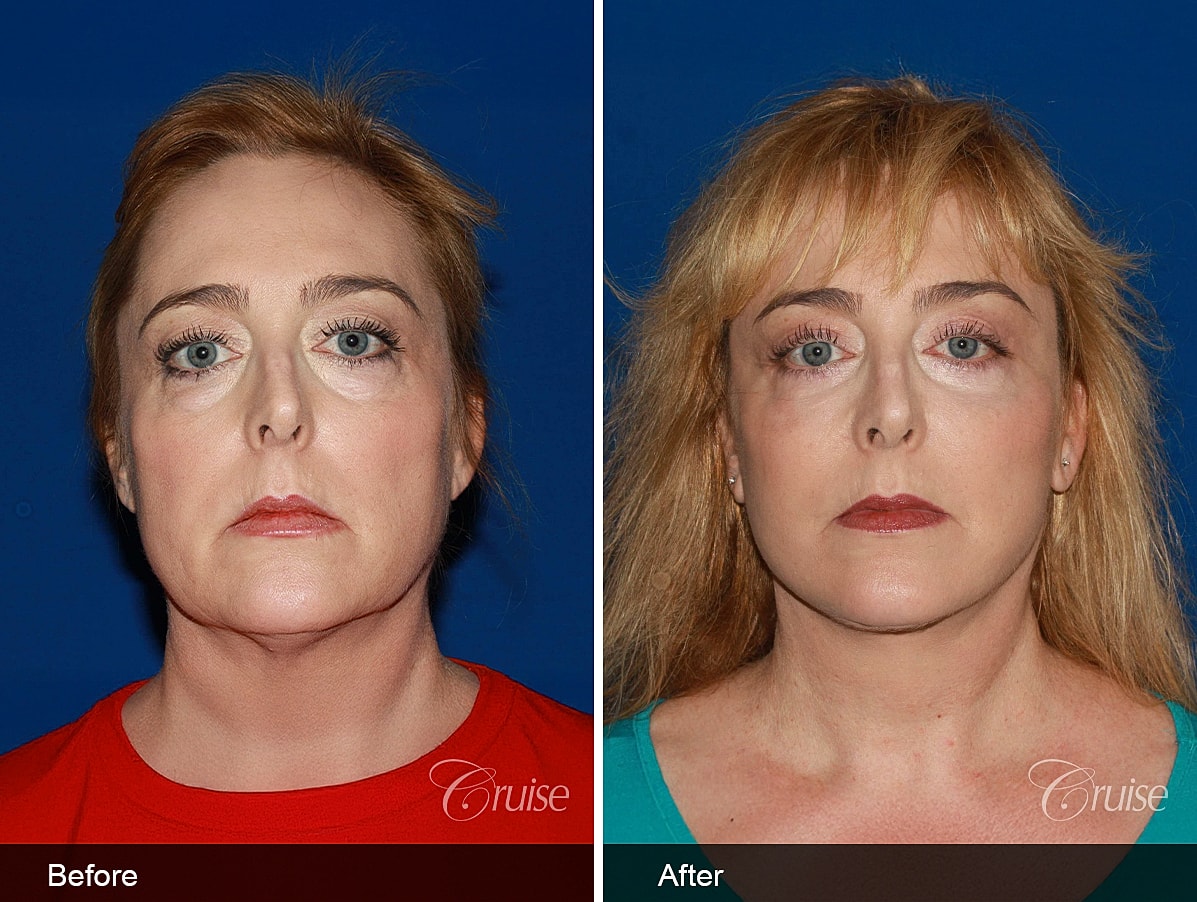 Face Lift Before & After