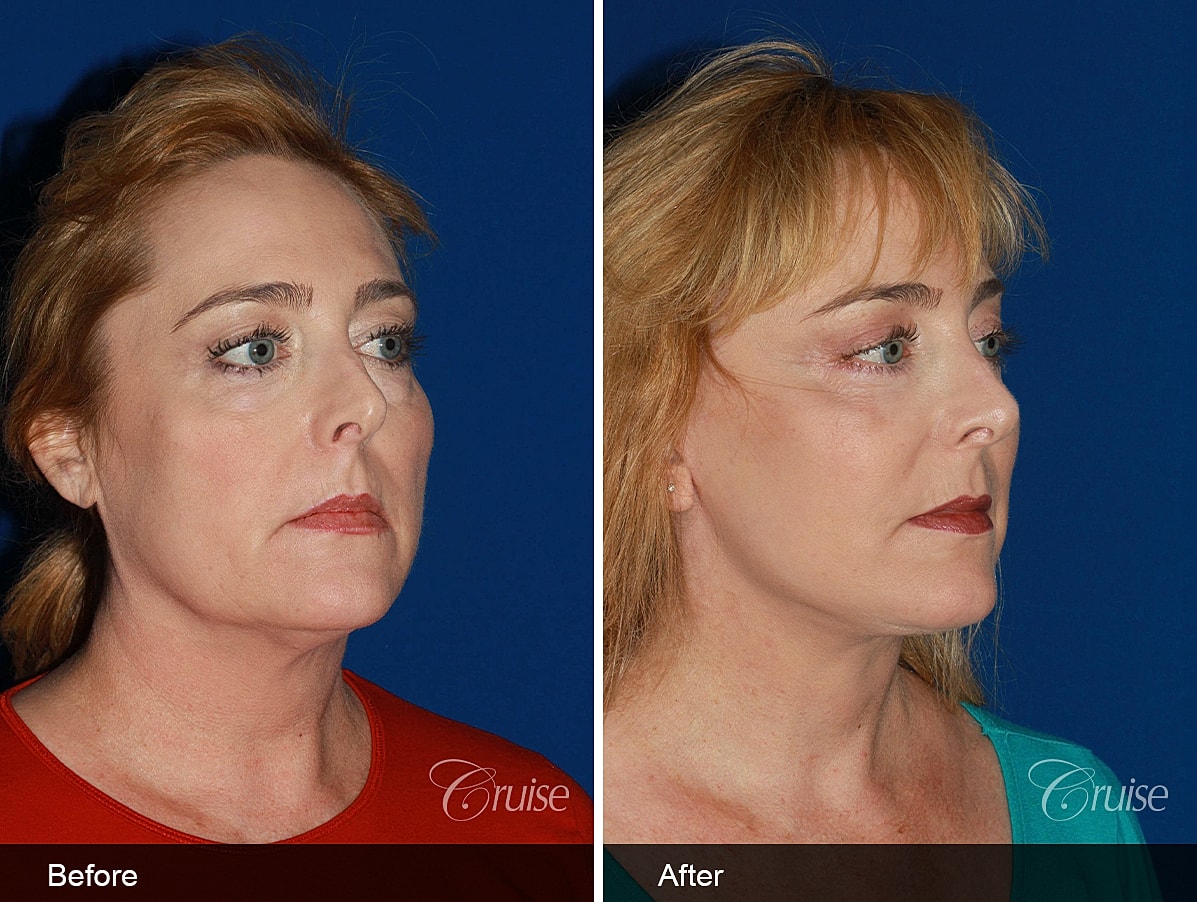 Face Lift Before & After