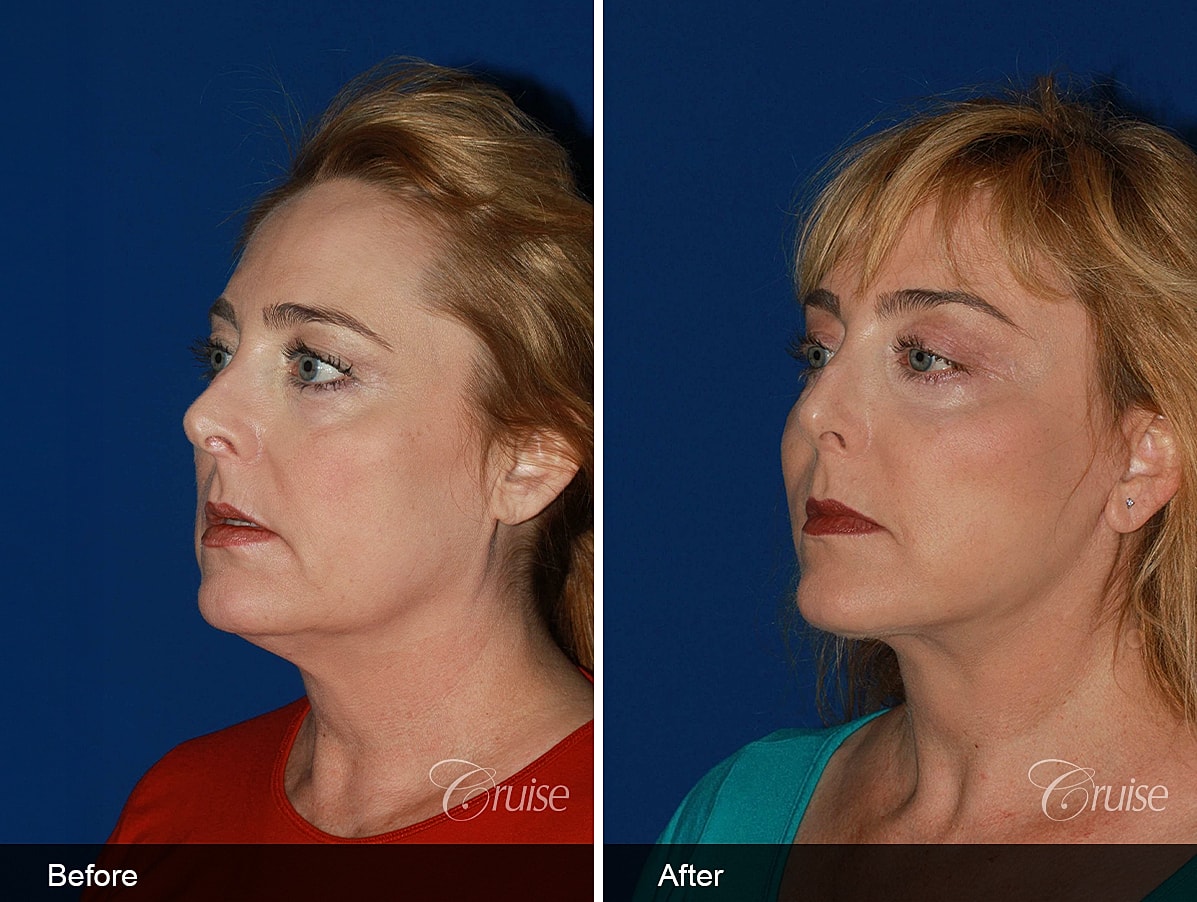 Face Lift Before & After