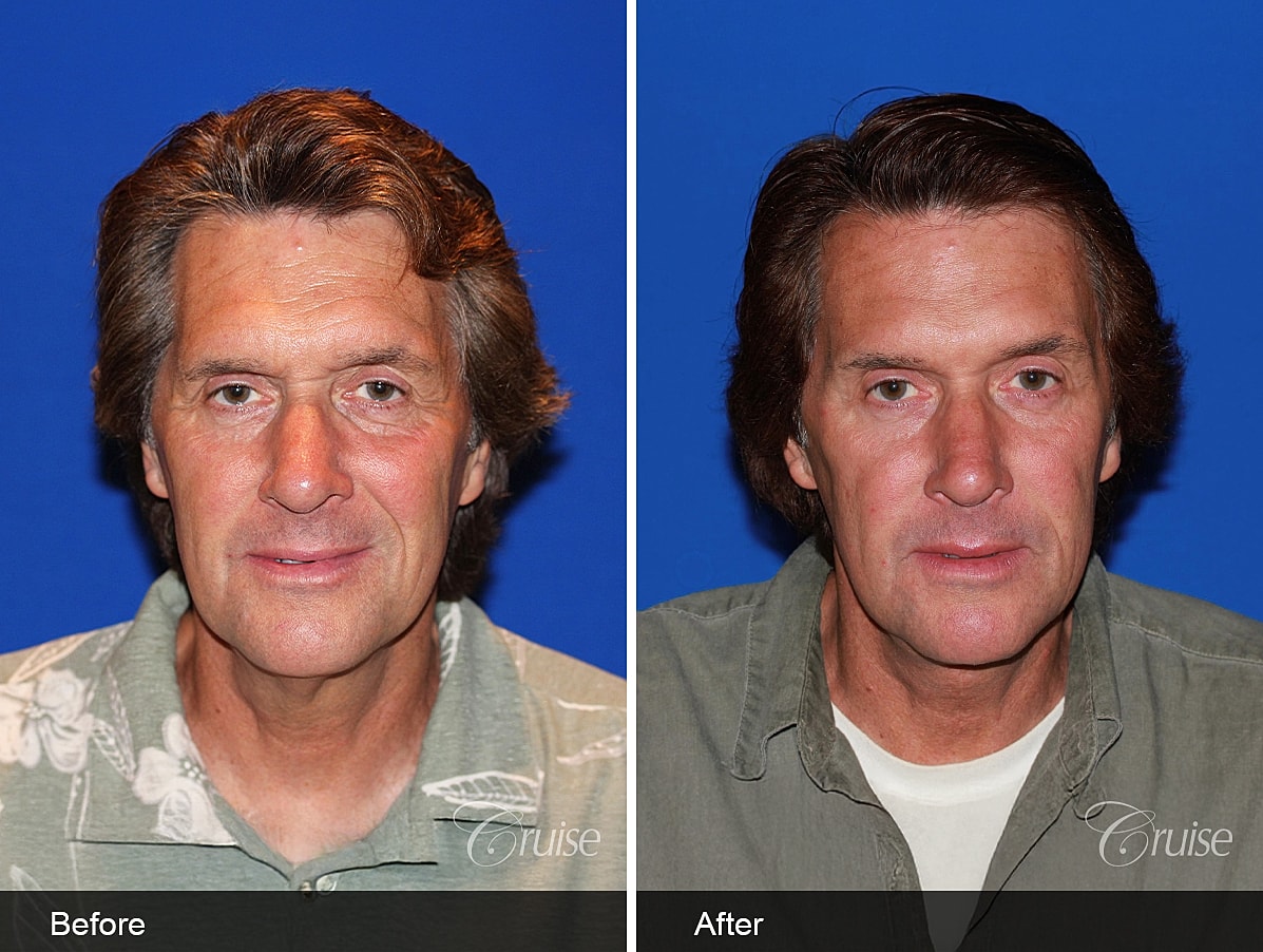 Face Lift Before & After