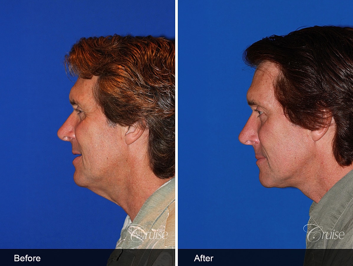 Face Lift Before & After