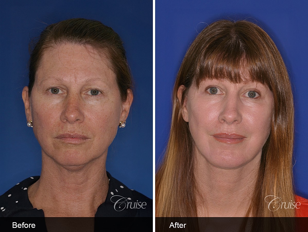 Face Lift Before & After