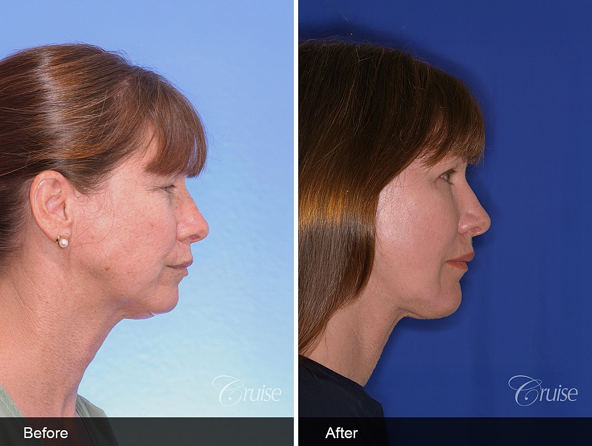 Face Lift Before & After