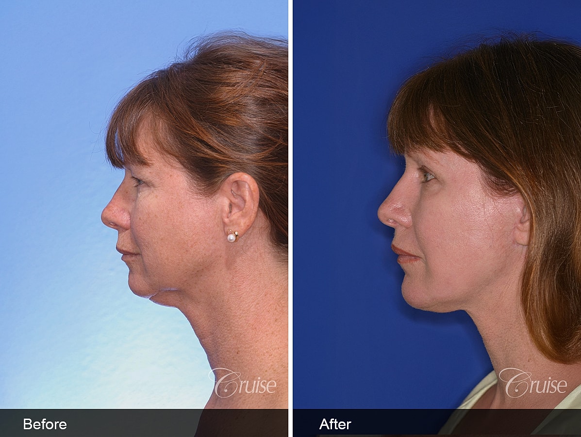 Face Lift Before & After