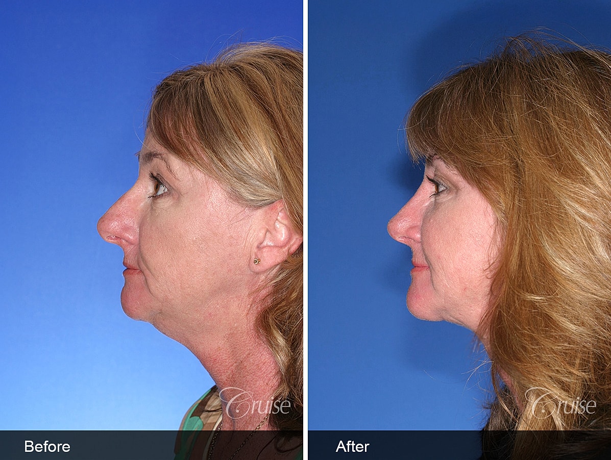 Face Lift Before & After