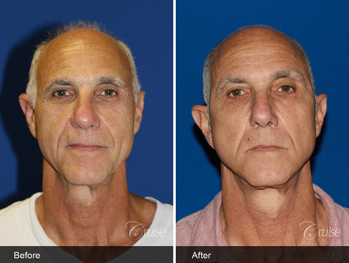 Face Lift Before & After