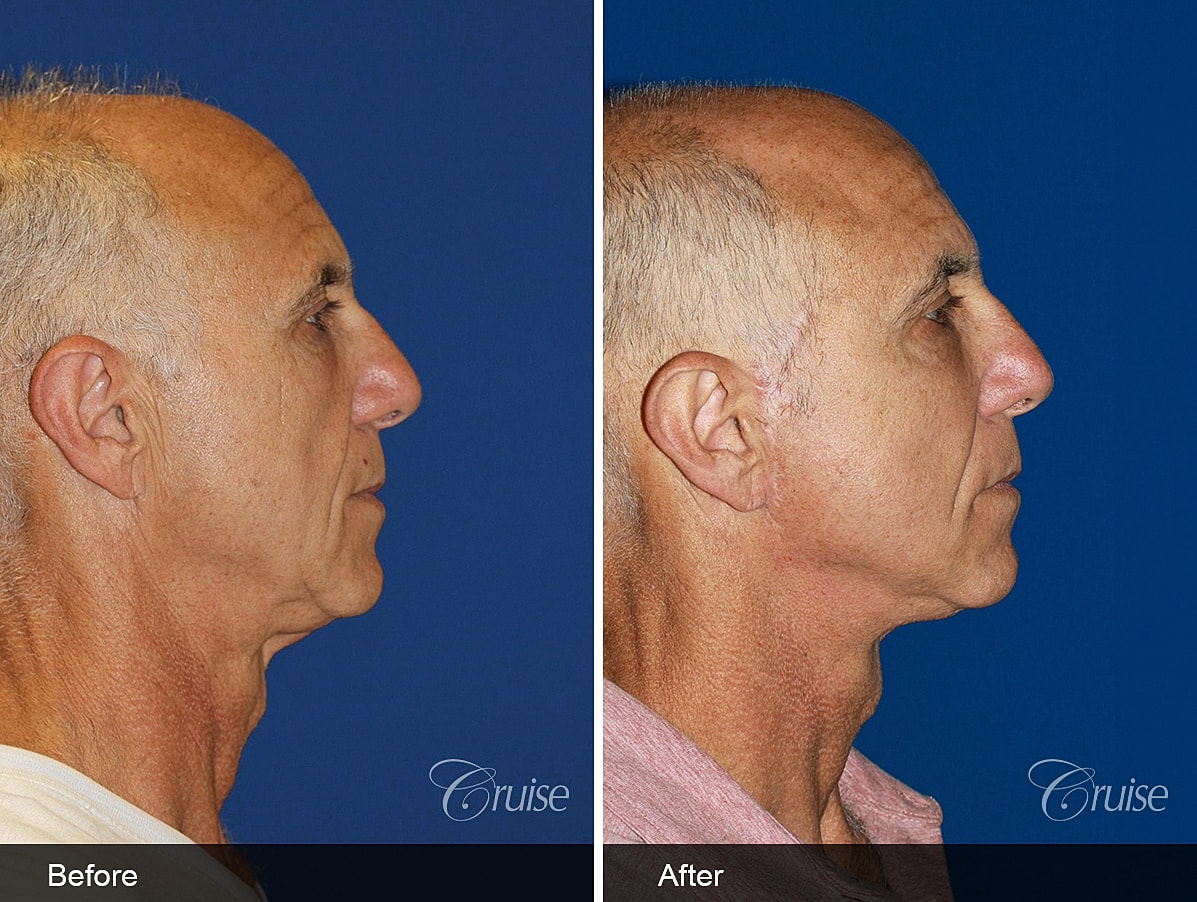 Face Lift Before & After