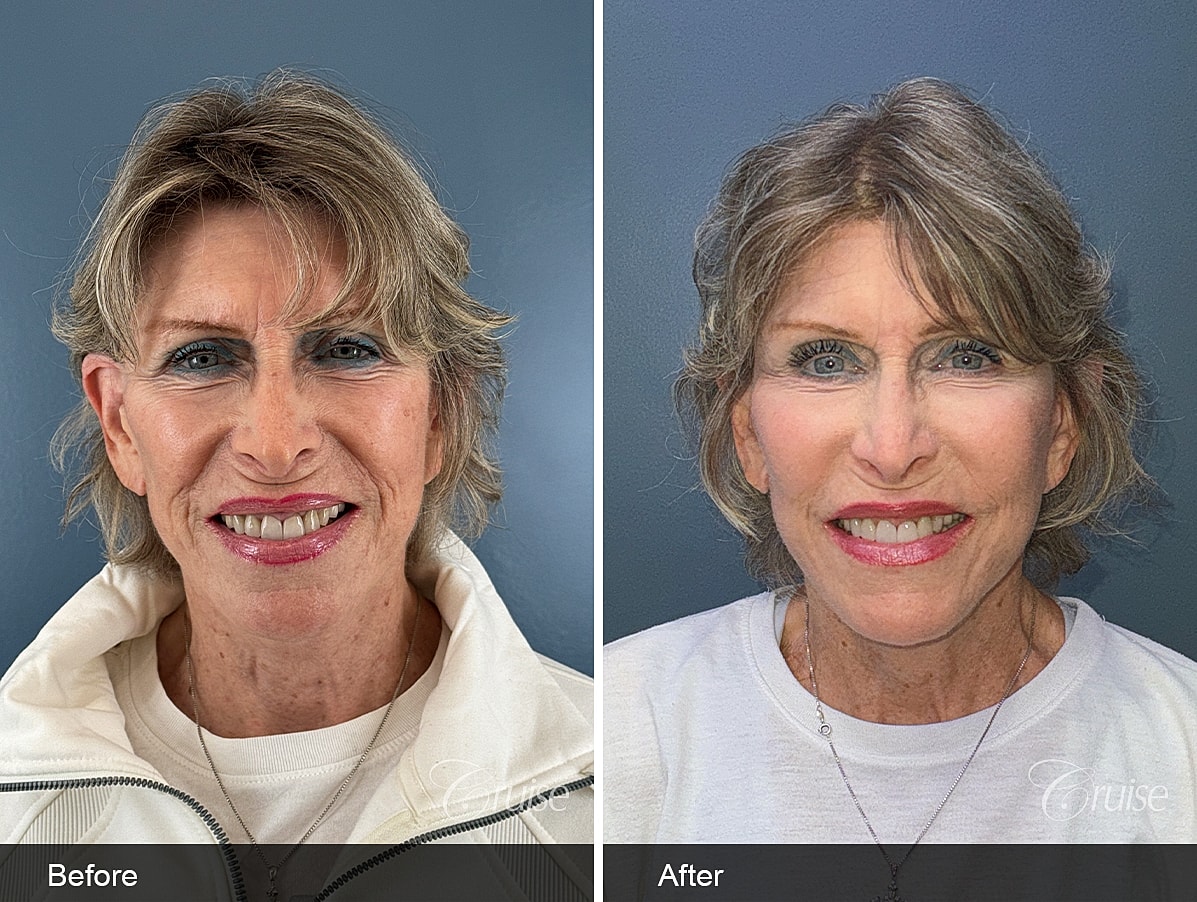 Face Lift Before & After