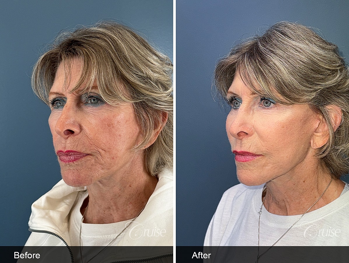 Face Lift Before & After